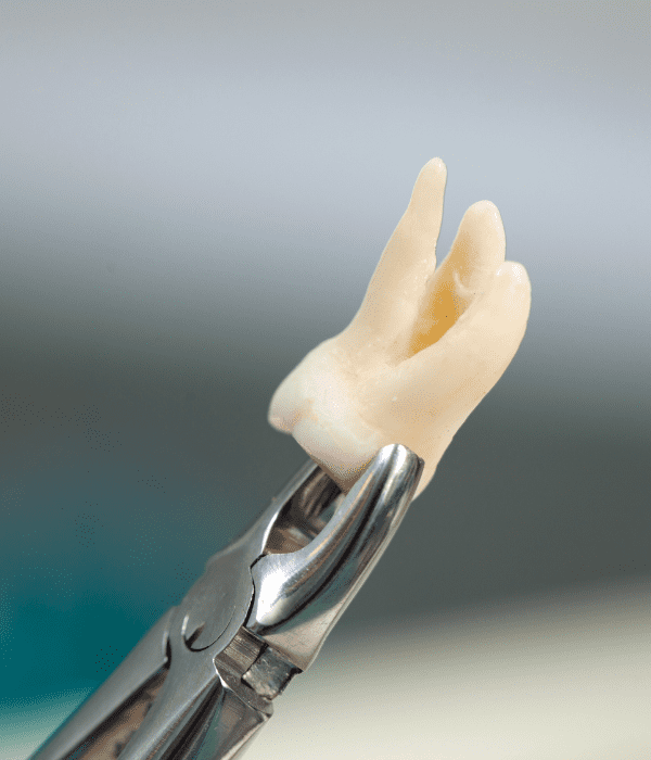 Cirugía de Muelas del Juicio