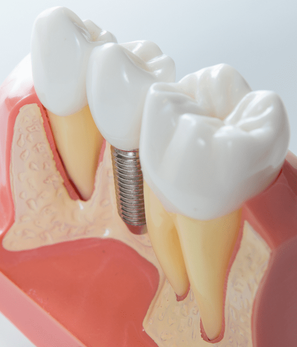 Corona Sobre Implante