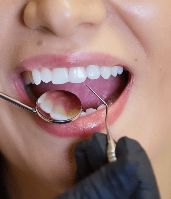 Incrustación Dental