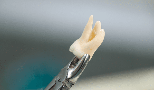 Cirugía de Muelas del Juicio