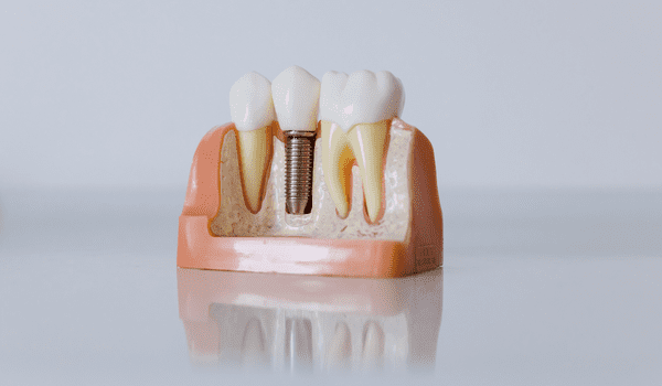 Implantes Dentales