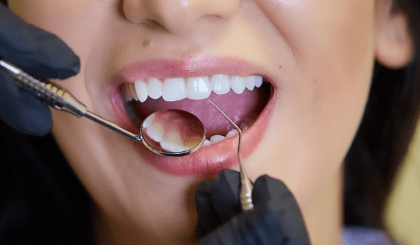 Incrustación Dental